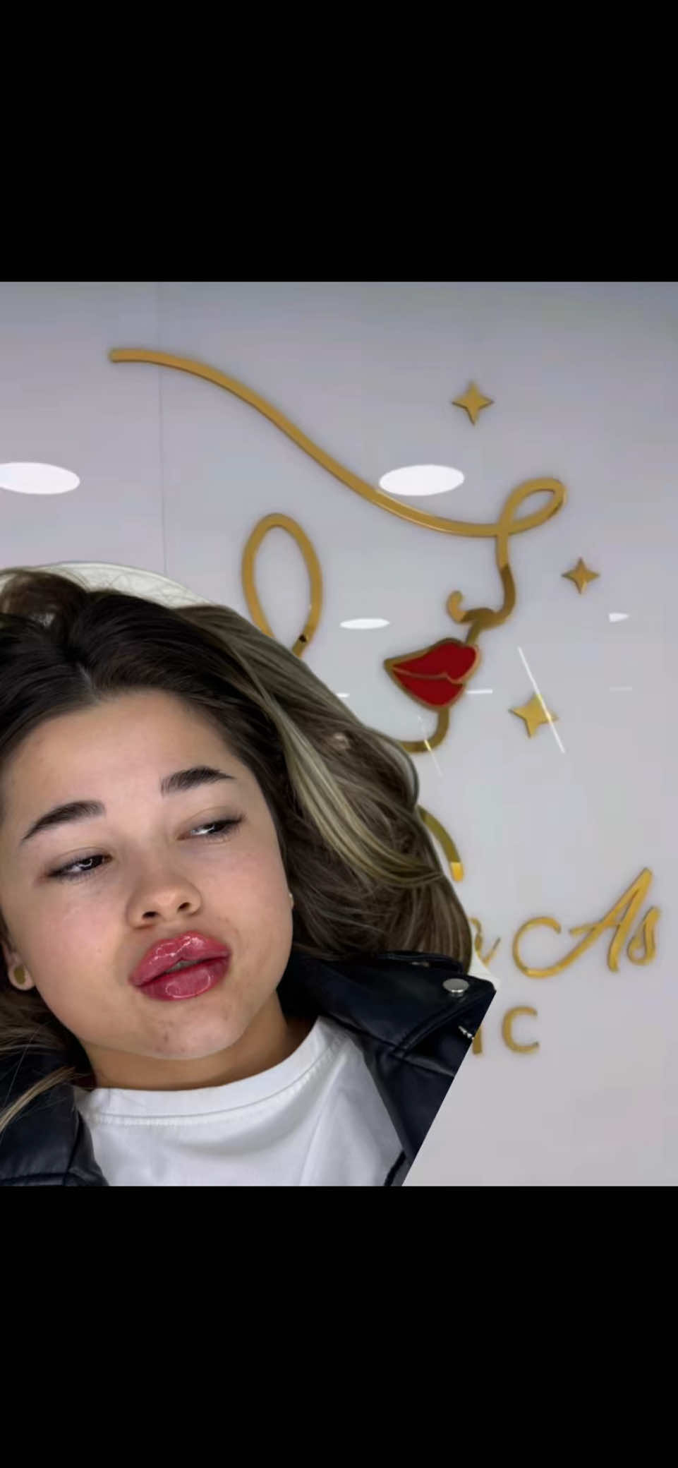 Russian Lips By Dr.Roxana As Aesthetic  ⚡️Pachet SUBLIME - topire AH + reinjectare 1 AH - 1290 lei redus de la 1990 lei  ⚜️Pachet LOFTY - augumentare buze 1 ml + alungire bărbie - 2000 lei redus de la 3000 lei 🫦💉Pachete PROMOȚIONALE Acid & Botox  ✔️1 ml acid - Revolax - 990 lei redus de la 1300 lei - consultație + anestezie + injectare ✔️Pachet 1ml Revolax + 3 zone botox 1790 redus de la 2790 lei - consultație + anestezie + injectare  #lipfiller #lipfillers #beforeandafter #lipinjections #beauty