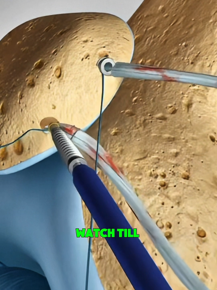 How Patella Replacement Surgery – How Surgeons Replace a Damaged Kneecap 🔩🦵 - 3D Animation. #PatellaReplacement #KneeSurgery #OrthopedicSurgery #MedicalEducation #SurgicalProcedure     