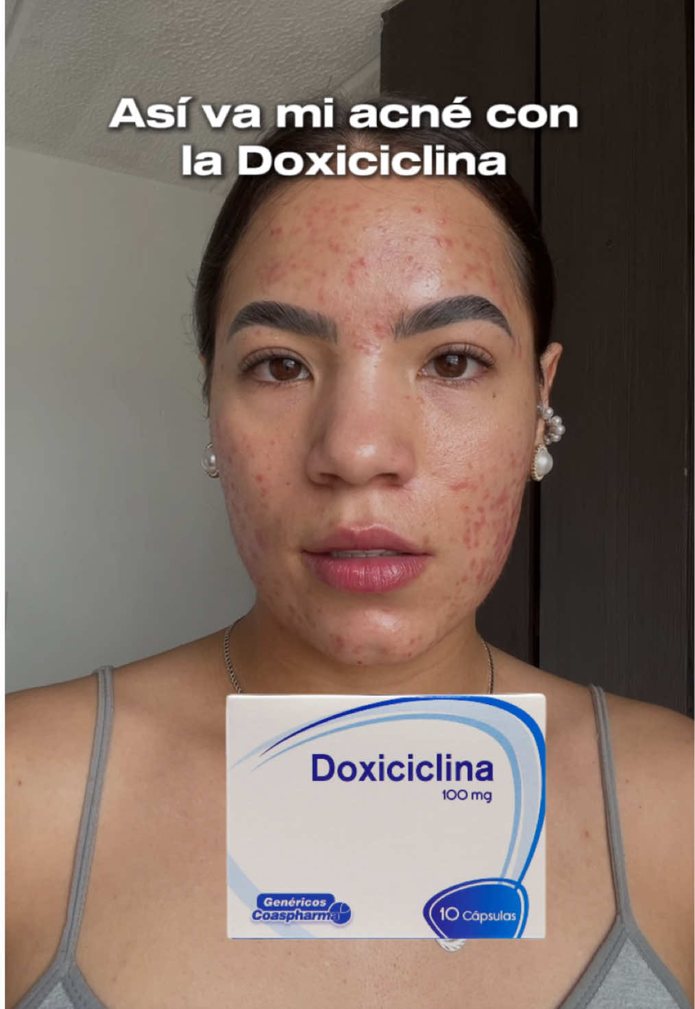 Así va mi acné con la Doxiciclina #acne #acnetreatment #acnefighter 