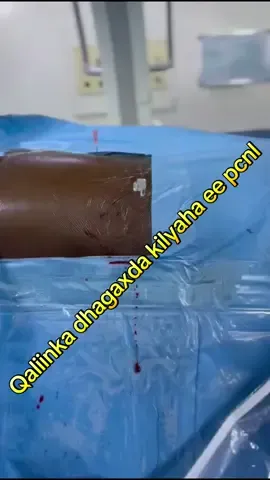 “Qalliinka PCNL maaha wax laga baqo — waa xal casri ah oo aan jeexis lahayn!” 💧 Dhagaxa kelyaha waa la saaraa, kelyahana waa la badbaadiyaa. #somalitiktok #somaliamogadisho🙏🇸🇴❤️❤️ #galaha