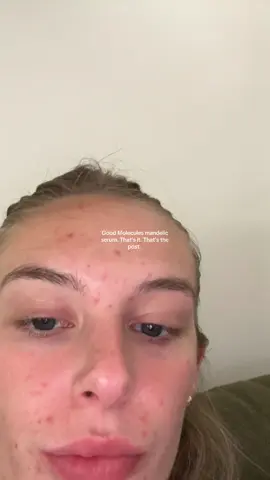 Only a month difference! @Good Molecules thank you for keeping my hormonal acne under control!! I still have some healing but omg WHAT A DIFFERENCE! 😩