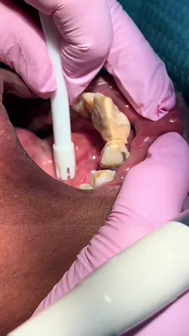Removing 30 years of tartar 🦷😳