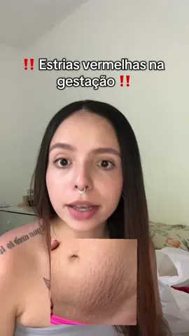 Como eu tratei as minhas estrias #estrias #mulheres #gravidez #fypシ゚ #dicasdebeleza 