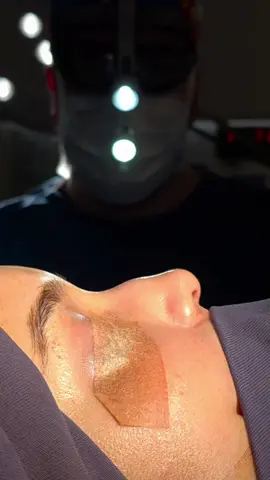 Rinoplastia Colombia 👃  . #rinoplastia #rhinoplasty #plasticsurgery #beauty #drluispedroza 