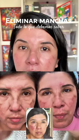 Cómo eliminar manchas profundas de melasma, acné o por el sol #melasma #manchasenlapiel #darkspots #rutinadeskincare #carosinmiedo 