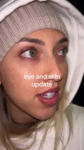 thank you internet best friends for all the eye and skin advice over the past few months. i really have appreciated it 🥹💗 #accutane #accutanejourney #accutanecheck #accutanetips #acnescars 