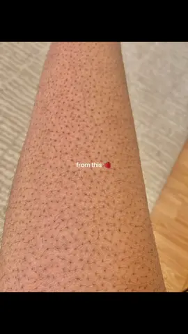 if your legs looks like this :: Use this effective set #retinolset #zuwacosmetics #madeinnepal🇳🇵 #goviral #skincareproductsbyzuwacosmetic #mildcleanser #vitaminc #