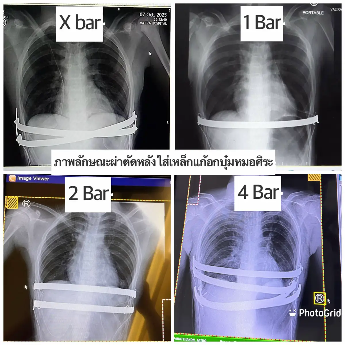 รีวิวผ่าอกบุ๋ม….ก่อน-หลังผ่าตัดเป็นไง