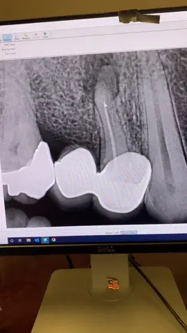 #dentists #dentalstudent #dentalhygienist #rootcanal #dentalofficelife 