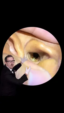 Part : Earwax not cleaned in 1 wee #satisfyingasmrtingsounds #earcleaningasmr #earwax #earwax #relaxingearcleaning 
