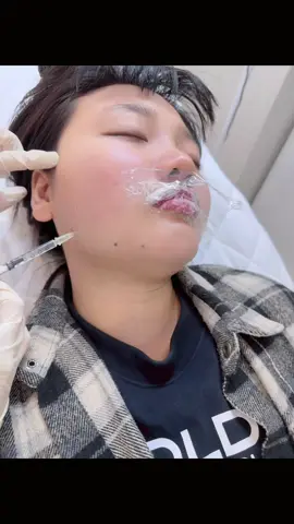 Thon gọn hàm bạnh💉#xuhuong #làmđẹp #NguyễnAnh #fillerbottox #thongonham 