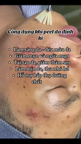 #xuhuongtiktok #nanmunchuanykhoa #carboxytherapy #peel 