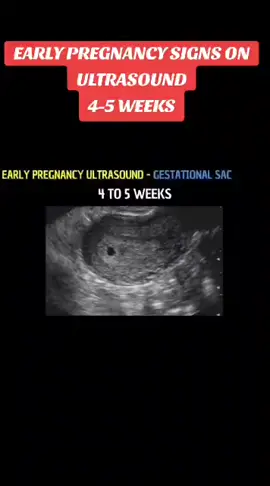 #firsttrimester #ultrasound #fyp #4weekspregnant #fyppppppppppppppppppppppp @🌲🌄Esther.million🇩🇪🌲🌲🕊️ @IdrisJj @phillemon26 
