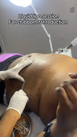 Liquid Lipo Fat Reduction - Heswall Laser ClinicLiquid lipo is a non-surgical, minimally invasive cosmetic procedure that uses injections to break down and eliminate localized fat deposits. It works by injecting a solution, often containing phosphatidylcholine and deoxycholate (PCDC), which dissolves fat cells, allowing the body to naturally metabolize and remove them over several weeks. It is a body contouring treatment for people near their ideal weight, not a weight loss solution, and is ideal for smaller, stubborn fat pockets in areas like the chin, abdomen, or thighs.   How it works A specialized solution, commonly a combination of phosphatidylcholine and deoxycholate (PCDC), is injected directly into the fat tissue.  The deoxycholate in the solution breaks down the fat cell membranes.  The body's lymphatic system then naturally metabolizes and eliminates the liquefied fat over several weeks, leading to a reduction in fat.  For some variants, a laser fiber is used to liquefy the fat before it is suctioned out, a process sometimes referred to as 