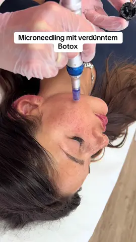 Schonmal Microneedling getestet? @MEDICARE BEAUTY  #microneedling #skinbotox 