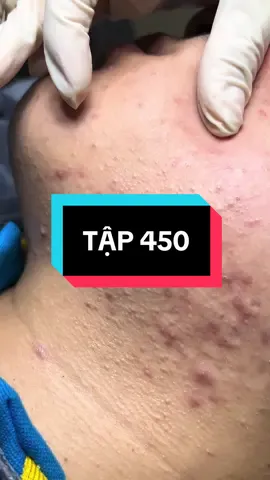 Mun ẩn #skin #skincare #skincareroutine #xuhuong2025 