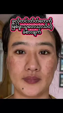 #တလစာနဲ့့သိသာတယ် #brထောပတ်သီးတင်းတိပ်ပျောက်ဆေး #မပျောက်ရင်ငွေပြန်အမ်းပေးပါတယ် #တင်းတိပ်အမဲစက်ပြောက်ချင်သူများအတွက် #foryou 