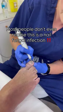 Fungal Nail Infections 🦠  That yellow, thick, or crumbly nail could be a fungal infection (onychomycosis) slowly spreading beneath the nail plate. Fungal spores thrive in warm, moist environments — like sweaty shoes or damp socks — and once they get under the nail, they’re hard to shift without professional treatment. 🩺 Early signs include: • Discolouration (yellow, white, or brown) • Nail thickening or brittleness • Lifting or crumbling edges • Itching or scaling between toes Left untreated, the fungus can spread to other nails or skin — and even cause discomfort when walking. 👣 Don’t ignore your nails. Get them checked by a Foot Health Practitioner — early care means easier recovery.  Katie Simner - Advanced Foot Health Practitioner & Wellness Clinic 💉 👣  Great Barr, Birmingham📍 Nail Trimming | Callus Reduction | Fungal Treatment | Corn Removal | Diabetic Foot Care | Athletes Foot Treatment | & So Much More!