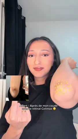 Avant après avec le Rétinal Shot de chez @celimax.global 8€ sur @YesStyle  #skincare #retinalshot #celimax #hyperpigmentation 