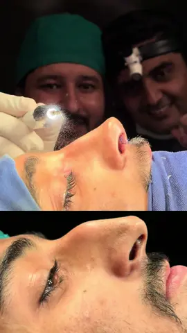 #foryou #dribrarent #rhinoplastyparachinar #dribrarrhinoplasty #rhinoplastypakistan 