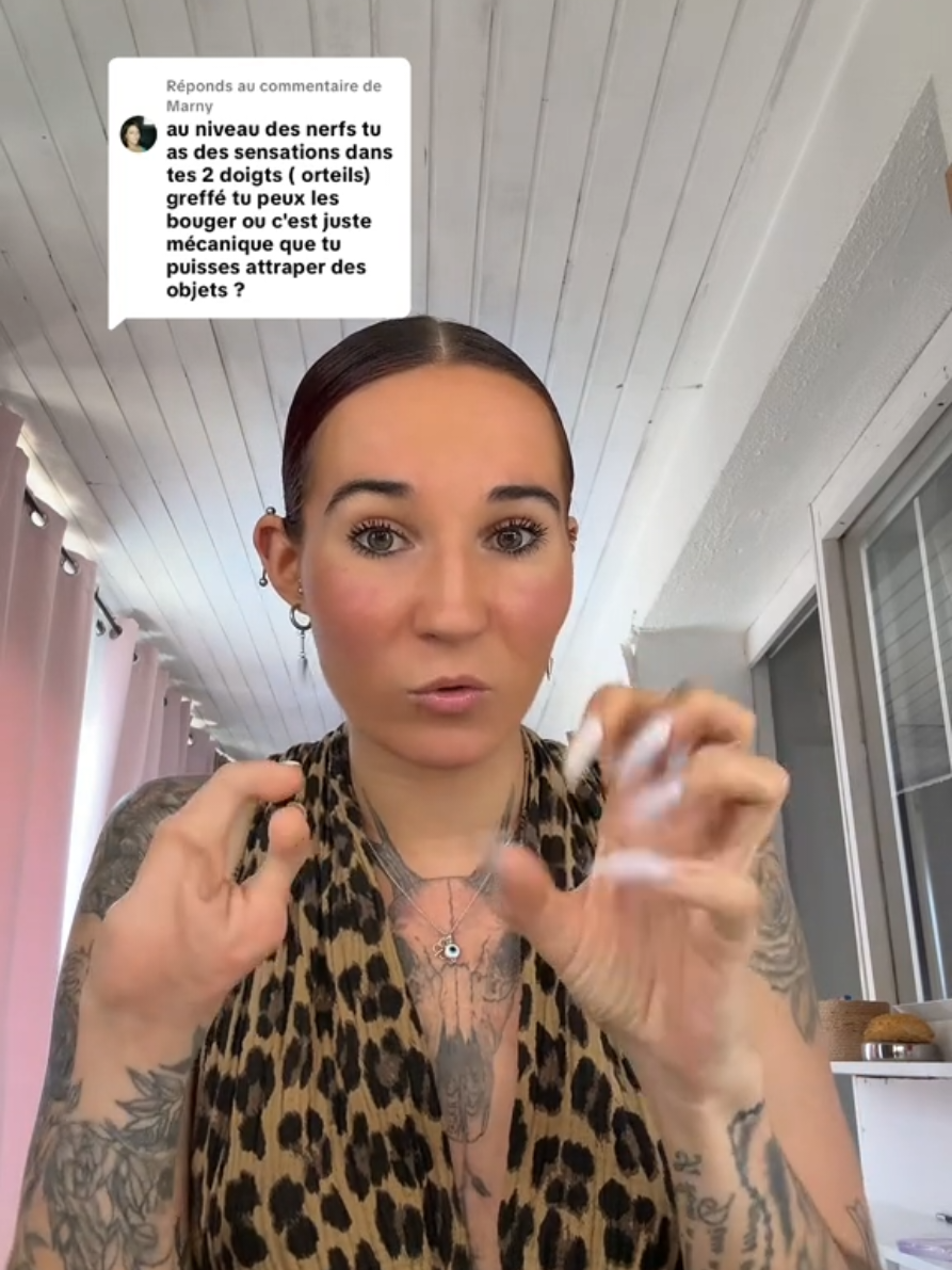 A esta hermosa mujer le pusieron dos dedos del pie en la mano para que pudiera ser mas funcional 🙌🏼🩷 #amputee #handless #disabled #disability #discapacidad 