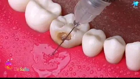 LOWER MOLAR SIX TOOTH CARIES REMOVEL WITH COMPOSITE RESTORATION #drsafiu #unfreezemyacount #foryoupageofficiall #lovedentistry #foryou 