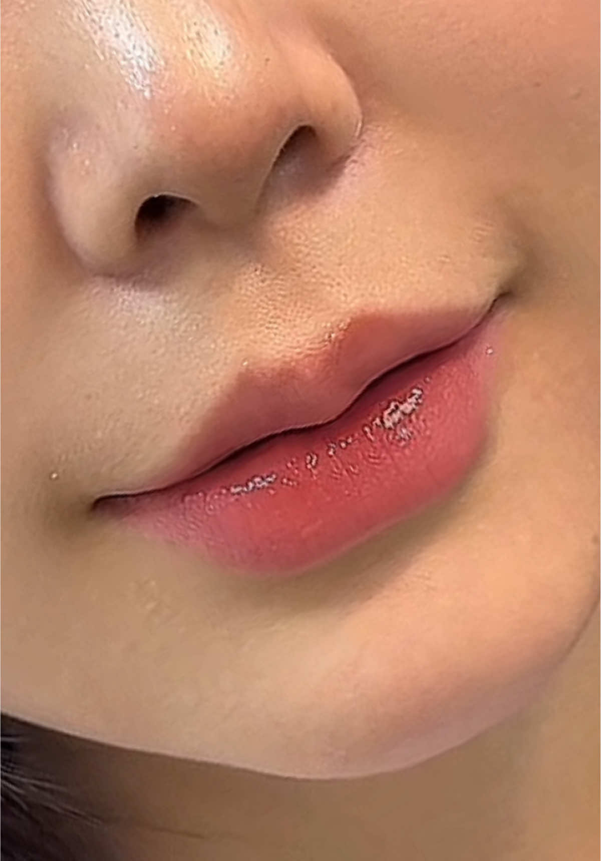 M O I#tiêmfullface #xuhuong #tiêmfille 