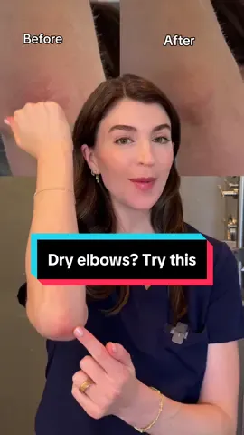 Dry, crusty elbows and knees? Not anymore. Thanks to @Suave.US new line of lotions formulated for specific skin needs. I'm loving their Calming Relief—lightweight, fragrance-free, and made with prebiotics to support your skin's microbiome. Perfect for those body parts we often forget about. Which one are you trying? #Suave #SuaveBodyLotion #SponsoredbySuave #suavepartner