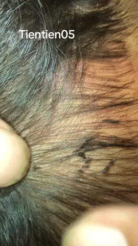 Remove lice 