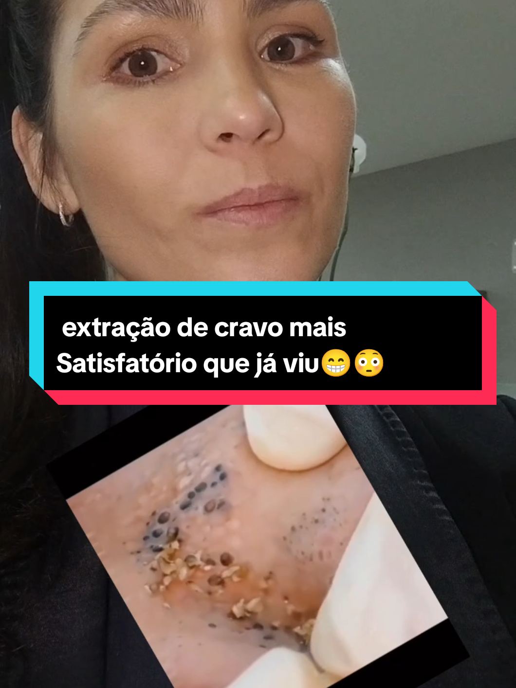 Extração de cravo Satisfatório 😁  #remoçãodecravo #react #asmr #fyp #satisfatorio 