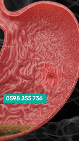The Faster And Effective Organic Products That Heals Ulcers And Eradicate H pylori Bacteria Completely.. #creatorsearchinsights #foreverlivingproducts #supplementsthatwork #ulcer #tiktok 