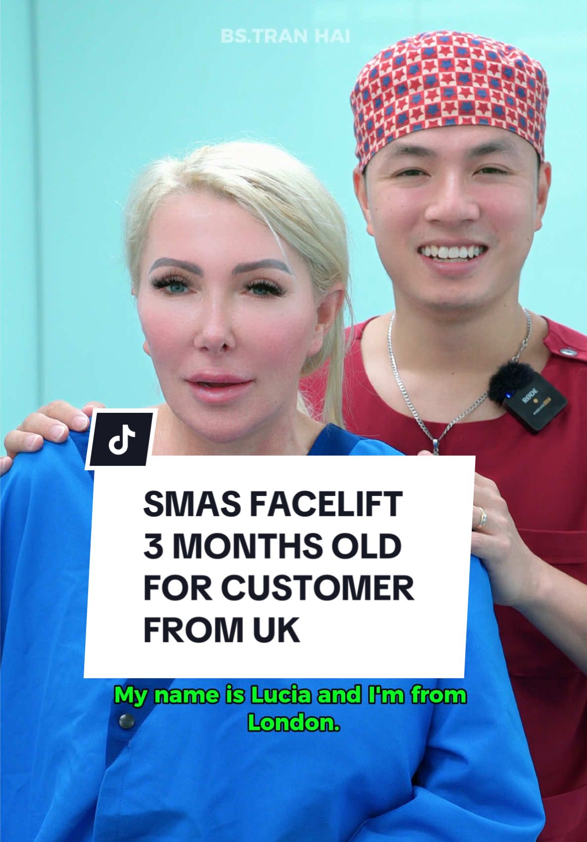 SMAS FACELIFT - 3 MONTHS OLD - FOR CUSTOMER FROM UK #facelift #facelifting #xuhuong #xuhuongtiktok #england 
