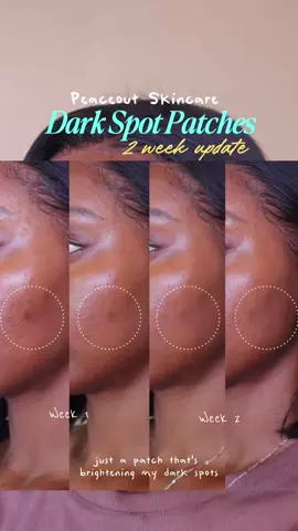 “No filter, no magic!” @ABBYROSEMAUREEN | SKINCARE ✨ secret to brighter, more even skin? Our Dark Spots Dots! Made with 430 dissolving microneedles, that help visibly brighten the appearance of acne scarring and dark spots 🙌 Avail always @sephora 💕