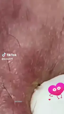 eezey peezee blackhead squeezee 🖤💗🖤#obsessed #face #Love #face #blackheads 