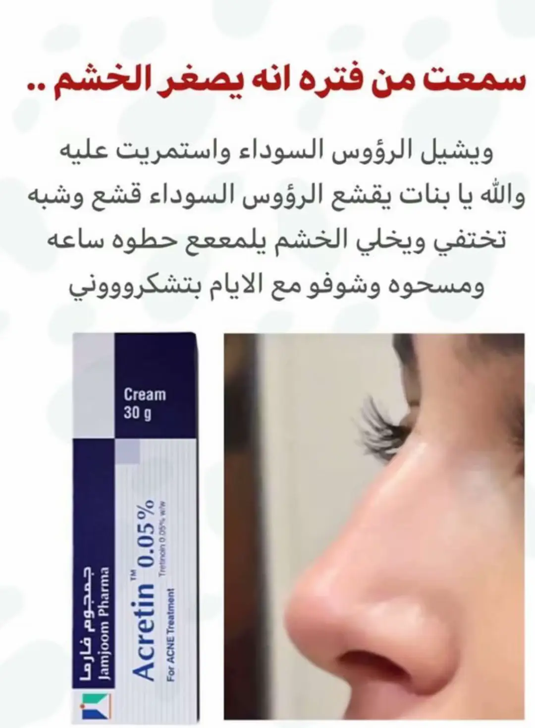 جربت كريم أكراتين فترة وفعلاً فرق معي! 😍 ينظف الرؤوس السوداء ويخلي البشرة ناعمة، وحتى شكل الخشم صار أنعم وأصفى! استخدموه باعتدال وبطريقة صحيحة، وراح تشوفون النتيجة مع الوقت ✨ #جربتها_وقلتها #روتين_الجمال #نضارة_البشرة #تفتيح_البشرة #نصائح 