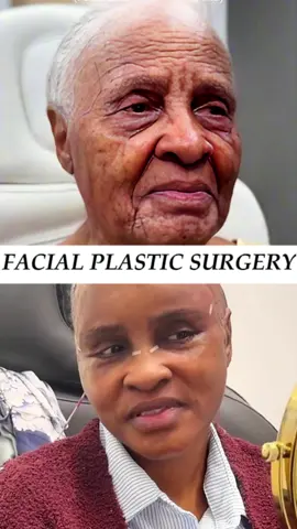 My Chinese three-point facial lift is a plastic surgery technique that completely improves facial sagging and wrinkles through surgical or non-surgical methods. The principle mainly includes the following aspects: 1. Enhancement of SMAS layer: The SMAS layer is a layer of connective tissue between the facial skin and muscles. By enhancing the SMAS layer, facial skin can be tightened, reducing wrinkles and sagging. 2. Ligament elevation: There are many ligaments on the face that connect the facial bones and muscles. By lifting these ligaments, the facial support structure can be enhanced and sagging can be reduced. 3. Fat reset: The distribution and location of facial fat can also affect the appearance of the face. By adjusting the position and distribution of fat, facial contours and lines can be improved The surgical process takes only 20 minutes to recover, and the recovery period can last for 2-3 days Sustainable results 15-20years #facelift #beauty #beautifyme #beforeandafter #antiaging