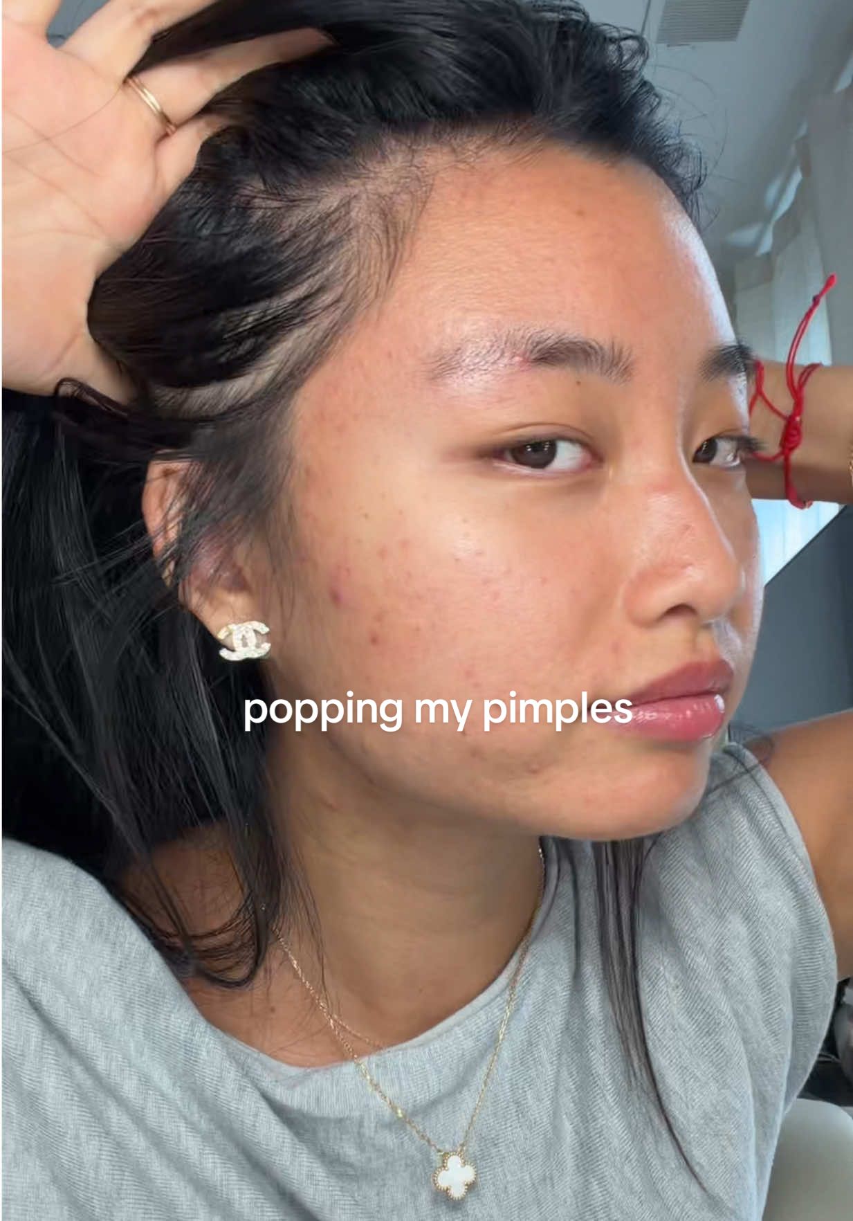 how did that blackhead even get on my LIP..also skin is crazy i hope it stays this way PLEASE🙏 #acne #pimples #acneproneskin #acnejourney  @@differin adapelene gel @target 