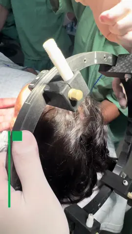 A neurocirurgia é incrível ❤️ #medicina #neuro #neurocirurgia #tumorcerebral 