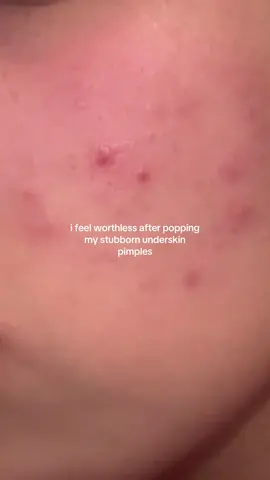 there are sm more its like a epidemic of them. every single pore has ones its making me feel sick and ugly.  #secertaccount #acnetreatment #pimplepopping #pimplepatch #underskinpimple 