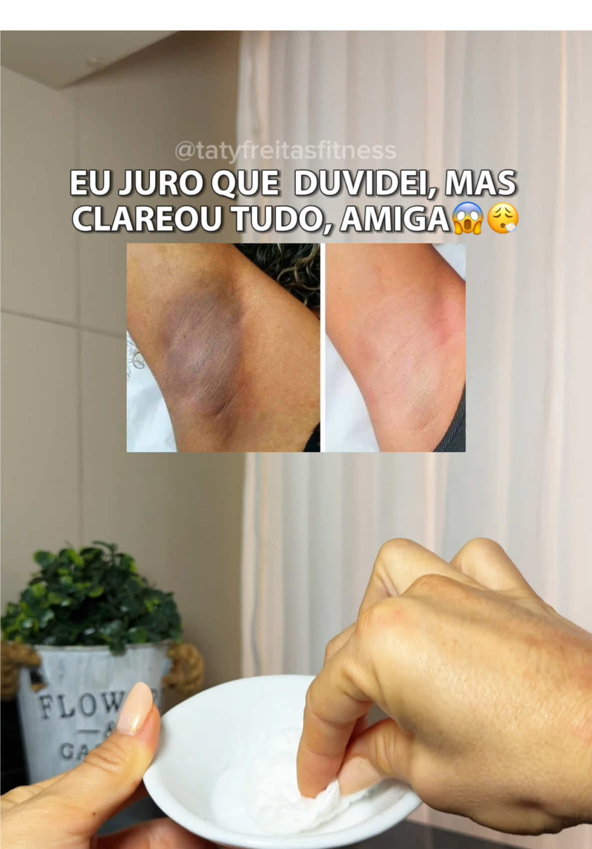 ✨O truque que ninguém acredita até ver o resultado!✨ Eu juro que duvidei, mas clareou tudo, amiga 😳 👉 Misturinha simples: 🔹 1 colher de bicarbonato de sódio 🔹 Soro fisiológico até formar uma pastinha 🧴 Pode usar em joelhos, cotovelos, axilas e virilha — pra mim funcionou demais! ⚠️ Não tem comprovação científica, mas muita gente (inclusive eu 😅) viu diferença! 💬 Me conta aqui se você já testou 👇 💾 Salva pra testar depois, amiga! ❤️ Curte e me segue pra mais receitinhas reais que funcionam! #dicasfemininas #clareamentocaseiro #cuidadocomapele #truquedebeleza #dicasdeautocuidado       