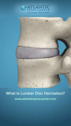 Understanding Lumbar Disc HerniationLumbar disc herniation occurs when the soft inner material of a spinal disc pushes through a tear in its outer layer in the lower back. This can press on nearby nerves, causing pain, numbness, or weakness.Common symptoms include:▪️ Lower back pain that may radiate to the buttocks, legs, or feet▪️ Tingling, burning, or shooting pain along the sciatic nerve▪️ Muscle weakness or difficulty standing or walkingAt Atlantic Spine Center, we specialize in precise diagnosis and a full spectrum of treatment options, from conservative treatments to minimally invasive procedures. Early evaluation can reduce pain and restore mobility.✨ Schedule a consultation today to explore your personalized treatment options.Learn more → https://www.atlanticspinecenter.com/conditions/herniated-disc/#lumbardischerniation #herniateddisc #disctreatment #spinehealth #sciatica