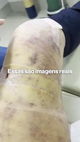 Você sabia? ⚠️ Considerações importantes: Esta publicação está de acordo com a resolução 2336/2023 do CFM. Os resultados são individuais, autorizados pela paciente, não reprodutíveis e não constituem promessa ou garantia de resultado para outros pacientes, podendo sofrer alterações com o tempo. CRMRS 27320 | RQE 21473 #lipedema #linfedema #comotratarlipedema 