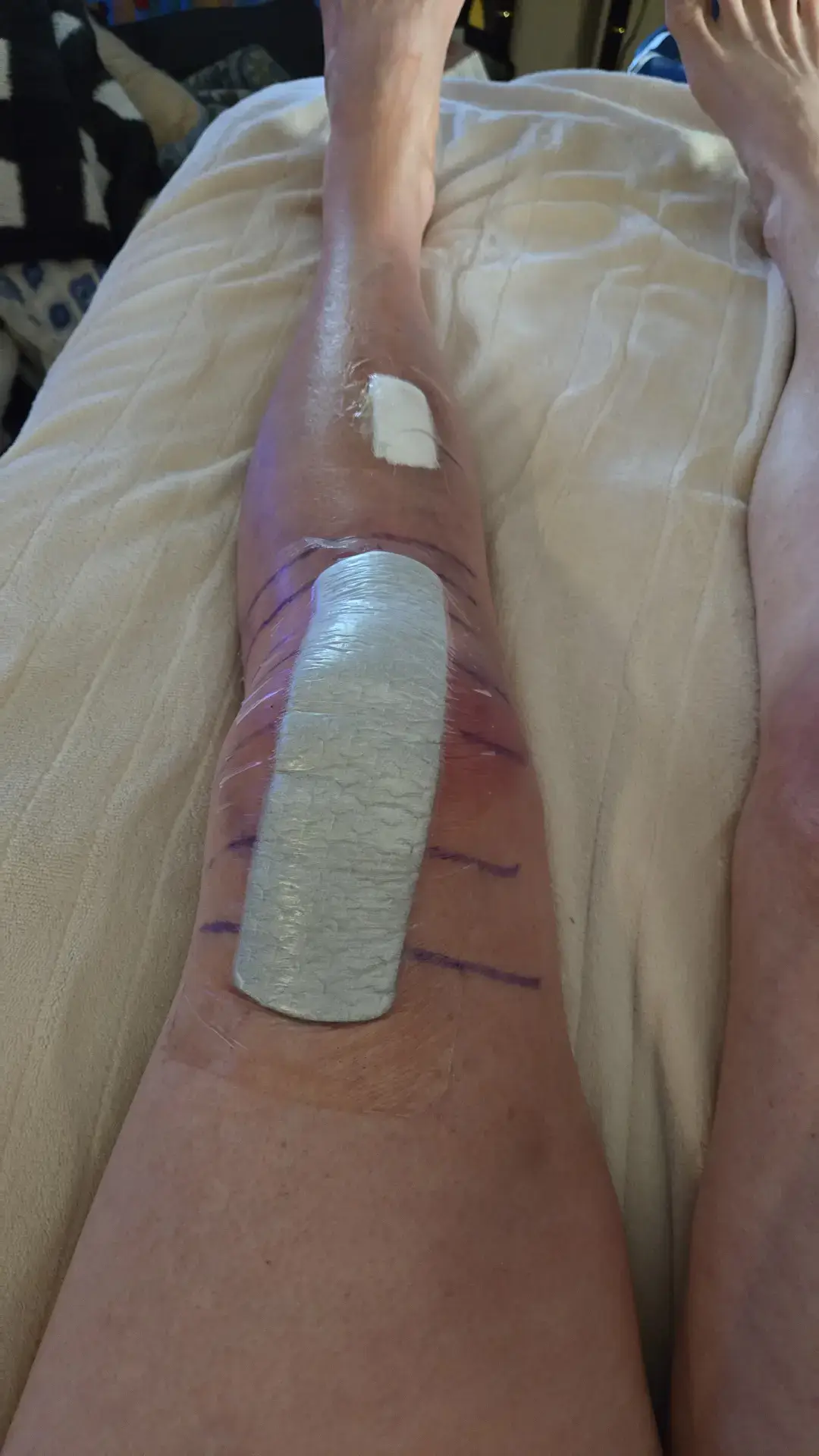 knee replacement on the left knee OUCH 😫 😒 