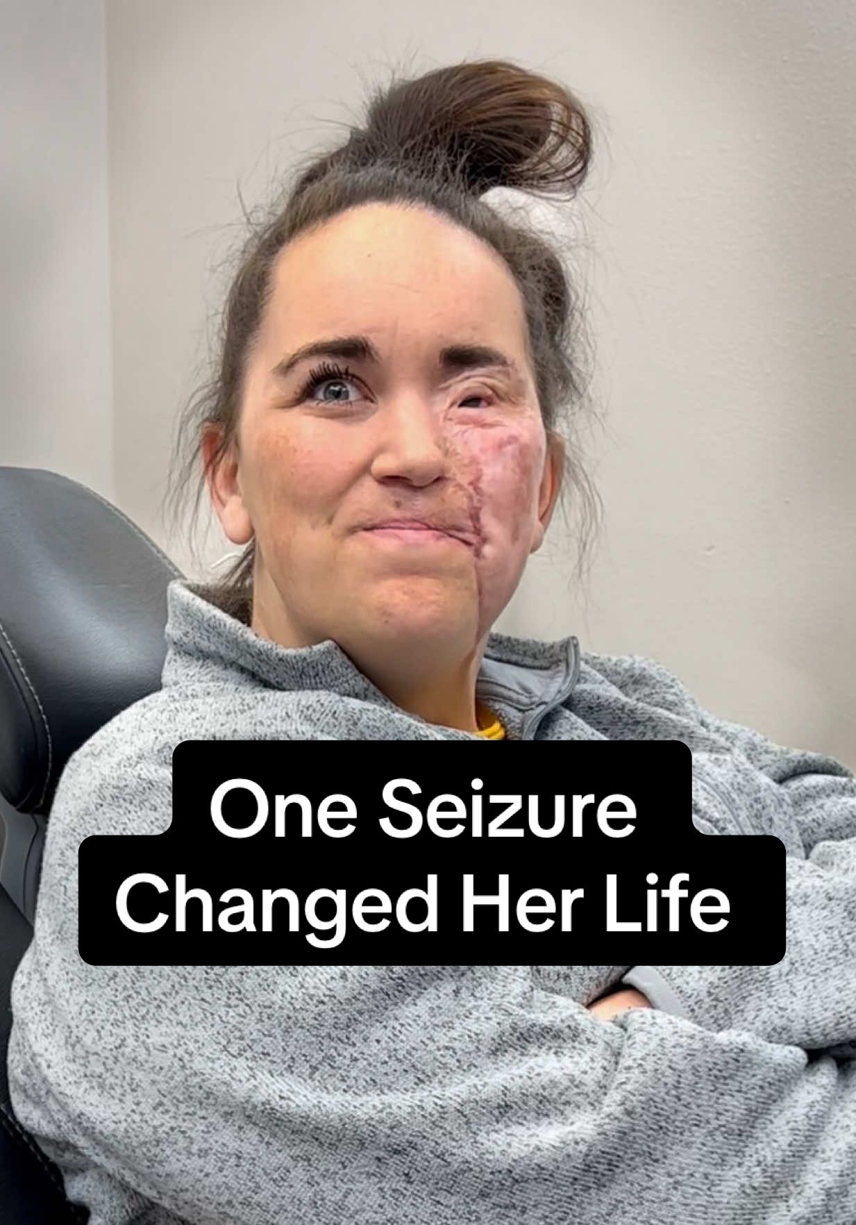 A seizure changed her life. A burn scarred her face. And years of falls took her teeth. But what no accident could touch — was her spirit. Today, she smiled again. And I’ll never forget that moment. #dentistry #accident #drkennysmiles #epilepsy #seizures   