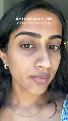 hyperpigmentation but skin should be starting to heal itself!! #microneedling #PRP #hyperpigmentation #scarring 
