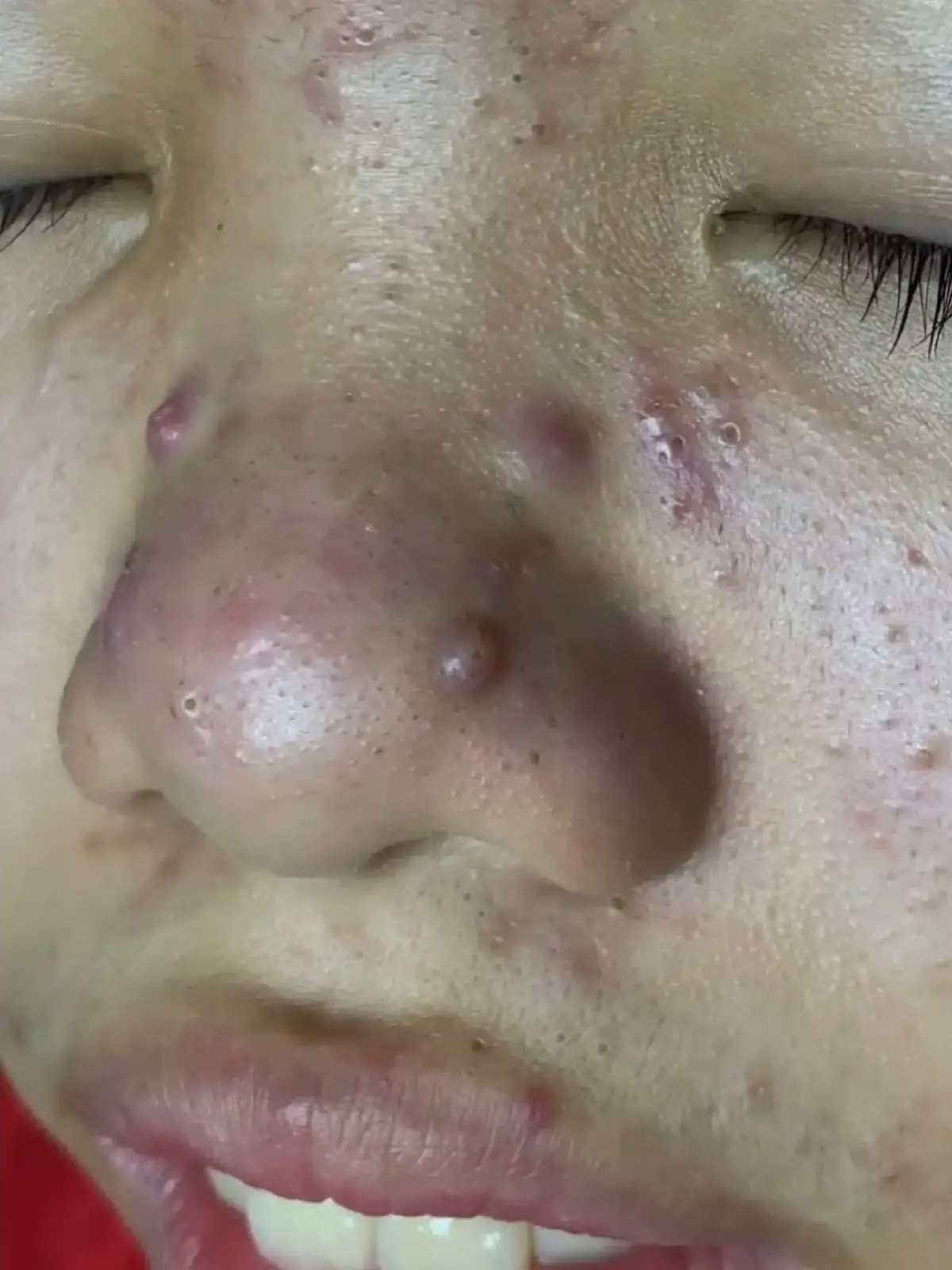 #pimplepopping #blackheadremoval #blackhead 