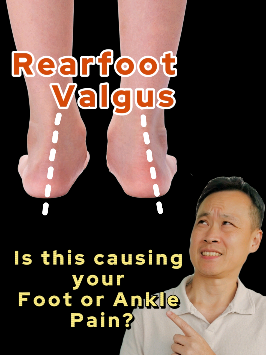 Rearfoot Valgus! Is this the cause of your foot or ankle pain? #rearfootvalgus #anklestability #anklesprain #plantarfasciitis #physioleslie 