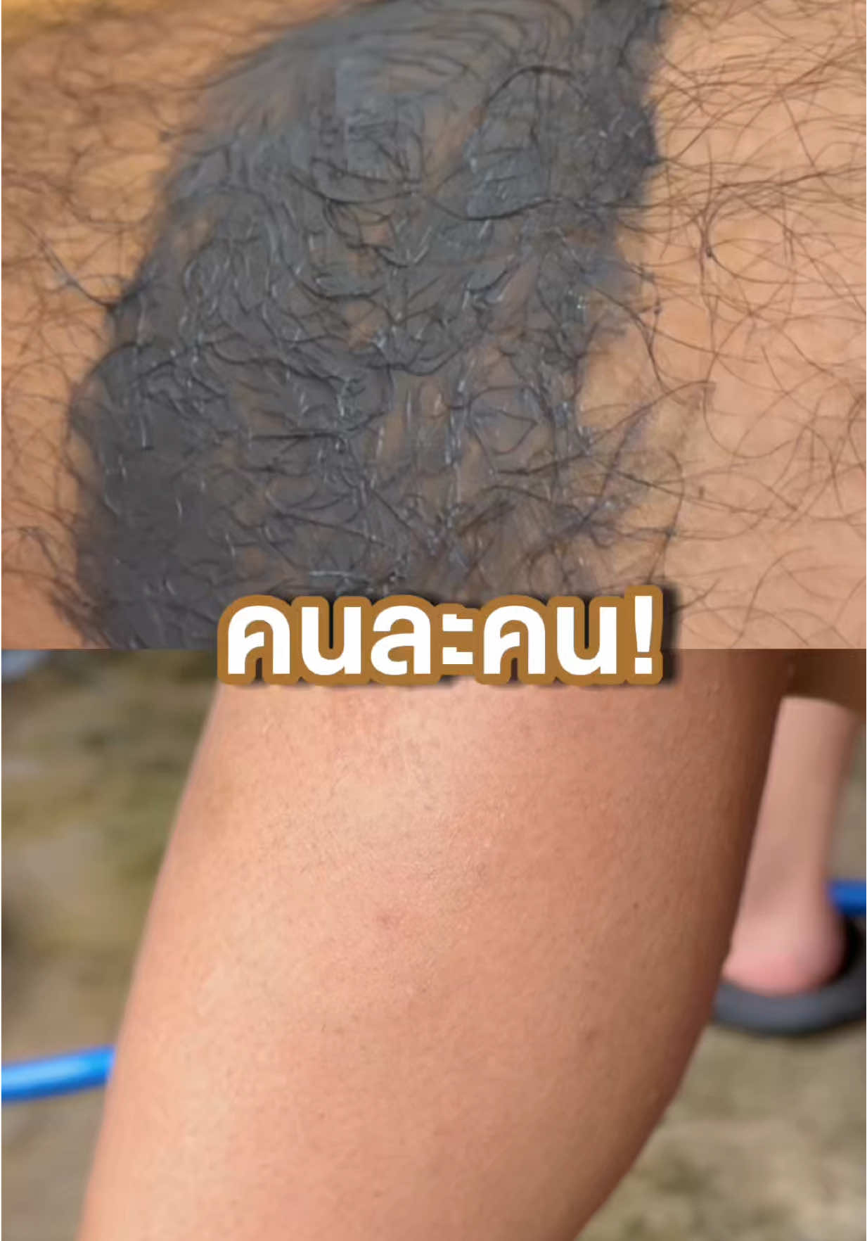 ทุกคนเป็นกันไหม? เวลากำจัดขนแต่เป็นตอ ขนคุด แสบ คัน #camellia #คามิเลีย #คามิเลียรีวิว #โคลนกำจัดขน #กำจัดขน 