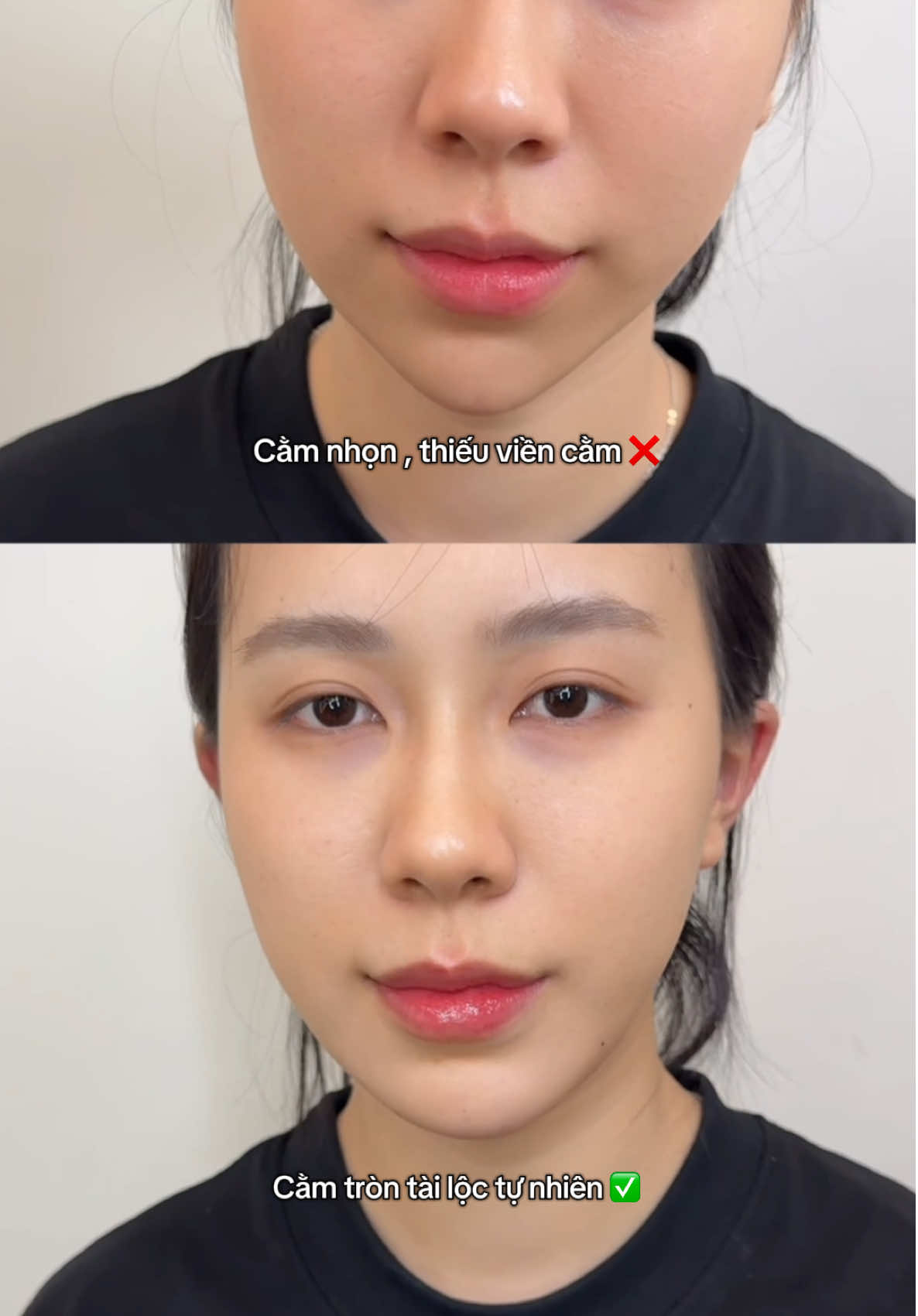 #tiemcam #fillerbotox #fillerhanoi #viral #xuhuong 