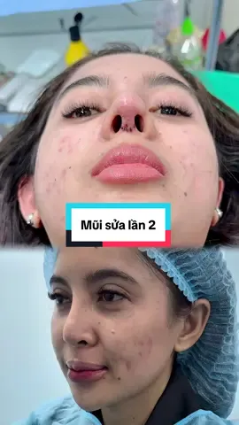 #indonesia🇮🇩 #viral #plasticsurgeonsoftiktok #nose #tiktokhongkongindonesia🇭🇰🇮🇩 #cosmeticssurgery 
